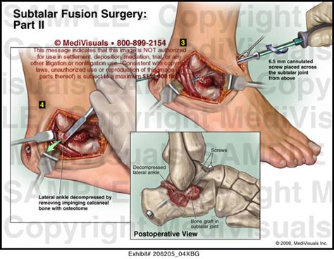 Medivisuals Subtalar Fusion Surgery - Part II Medical Illustration