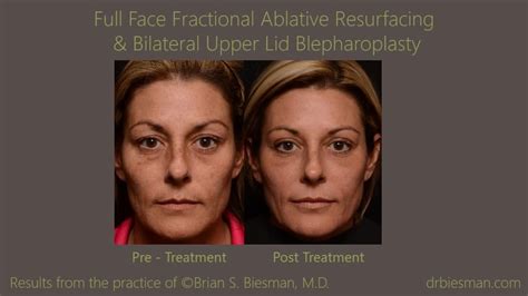 Laser Skin Resurfacing Before and After Gallery | Nashville, TN