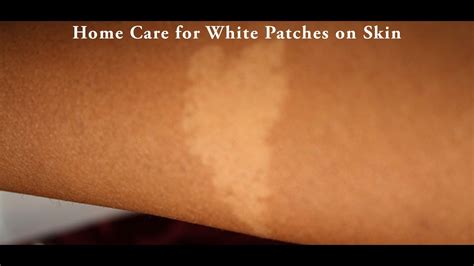 10 Reasons Of White Patches Or Spots On Your Skin 10