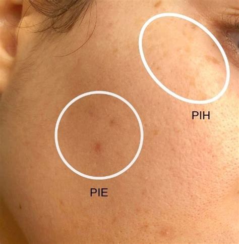 Acne Scarring, PIH & PIE: Differences, Causes & Treatments — Babe ...