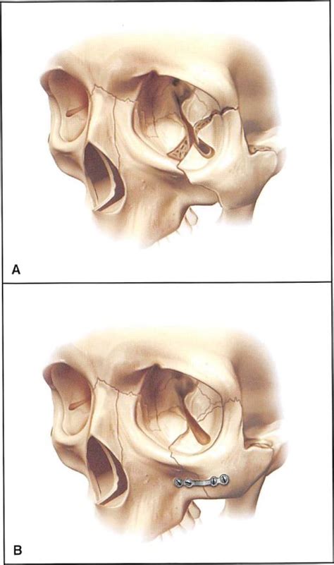 Zygomatic Arch Fracture Treatment