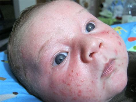 Baby Acne Symptoms, Causes, Diagnosis and Treatment - Natural Health News