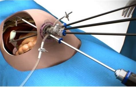 SILS/Scarless Cholecystectomy (single incision laparoscopic ...