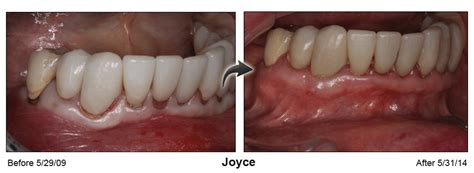 Pinhole® Surgical Technique - Pacific Smiles Dental Implant Center