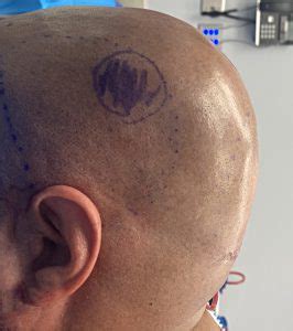 Plastic Surgery Case Study - Male Occipital Bun Reduction by a High Speed Burring Technique ...