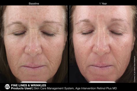 Jan Marini Before & Afters - Fine Lines & Wrinkles - Clever Beauty