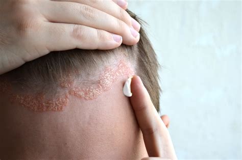 What is Seborrheic Dermatitis? - seborrheic dermatitis in scalp