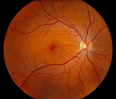 A Detailed Study on Cystoid Macular Oedema, Diagnosis, Treatment