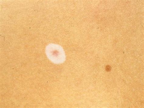 halo nevus - pictures, photos