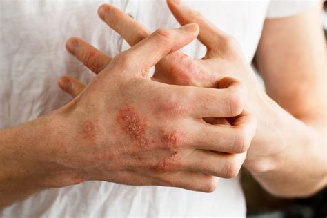 Atopic Dermatitis Causes