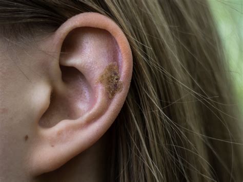 What Causes Scabs In My Ear? – Balmonds