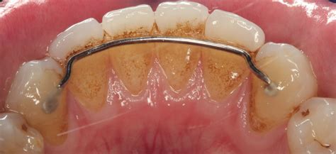 How Long Do Retainers Last After Braces at Scott Guarino blog