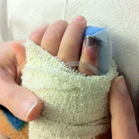 The necrotic little finger of her right hand at a later stage. Bandages... | Download Scientific ...