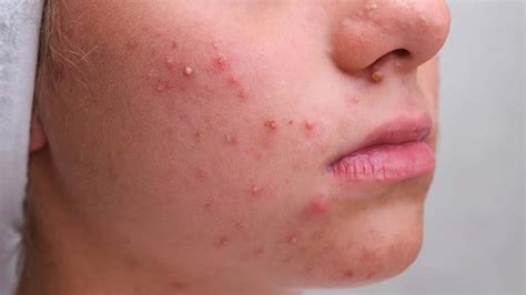 What Causes Cystic Acne? – NutritionFact.in