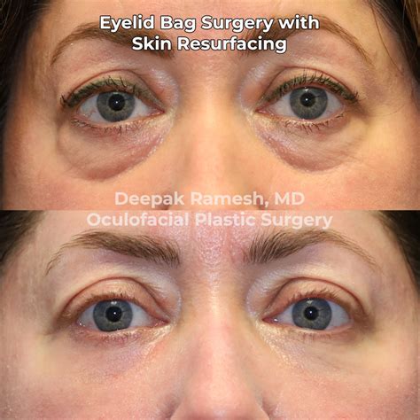 Skin Resurfacing in New Jersey | Center for Eye & Facial Plastic Surgery