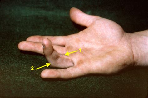 A-2 PULLEY RUPTURE (FLEXOR TENDON SHEATH RUPTURE) | Hand Surgery Resource