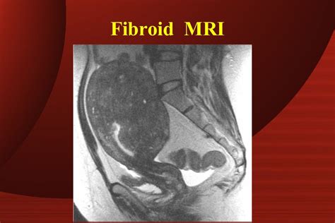 Fibroid uterus