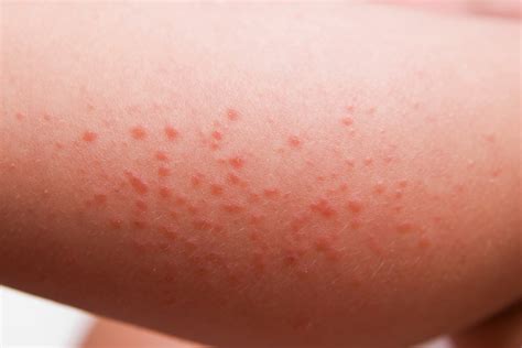 Celiac Disease Rash (Dermatitis Herpetiformis) Explained - Good For You Gluten Free