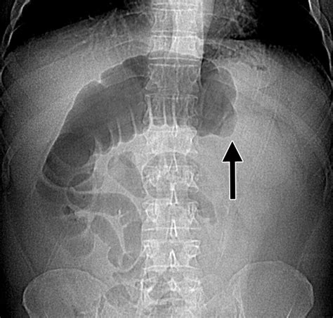 Large-Bowel Obstruction in the Adult: Classic Radiographic and CT ...