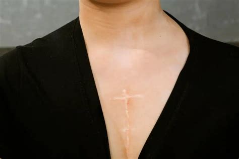 Open Heart Surgery Scar Healing: How to care scars | Miami, FL