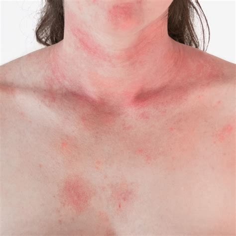 Common Adult Skin Rashes Symptoms Causes Treatment - Gambaran