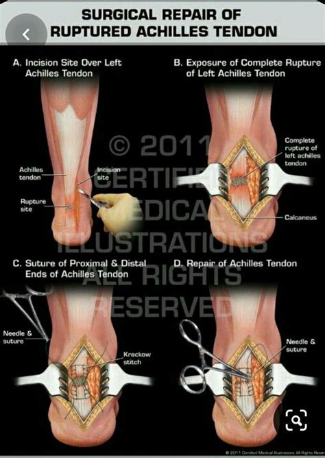 Pin on Foot Pain remedy & info