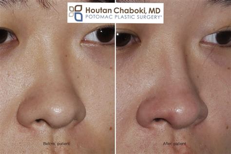 Augmentation Rhinoplasty without Breaking the Nose