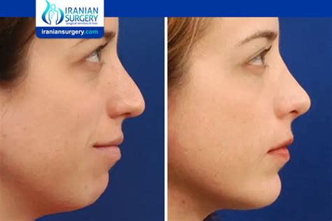 Chin Implant Risks |Chin Implant Risks and Complications |Iranian Surgery