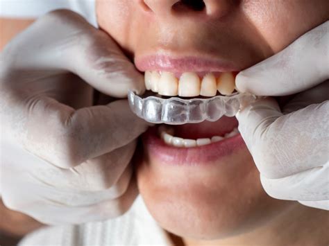 Retainers vs Braces: What You Need To Know | Aegis Dental Group