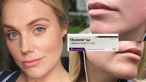 ACZONE DAPSONE GEL 5% REVIEW | Chronic Adult Acne 2 Month Progress 2021 - YouTube