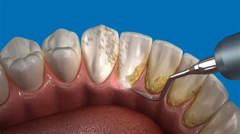 Calculus Bridge: Causes, Risks and Treatment – welzo