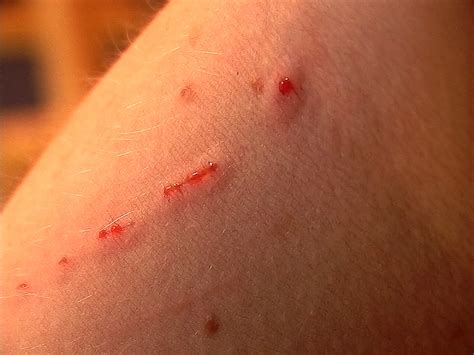 Cat Scratch Disease Bacteria