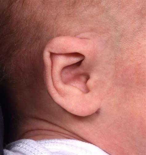 Newborn Ear Correction Case 5244 - Aviva Plastic Surgery