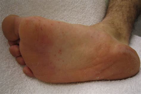 Brown Spots on Ankle Causes, Symptoms and Treatments for 2021!