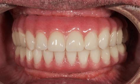 Smile Gallery | Hybrid Denture (all-on-6) | Aurora CO Dentist