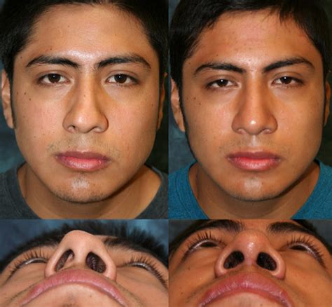 Nose Cartilage Damage