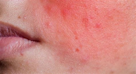 Most Common Causes of Localized Facial Rash | Healthnews