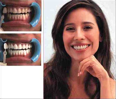 What Are the Different Types of Tooth Bleaching Products? | Dental Bleaching Berlin