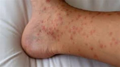 Red Dots On Bottom Of Foot Best Sale | emergencydentistry.com