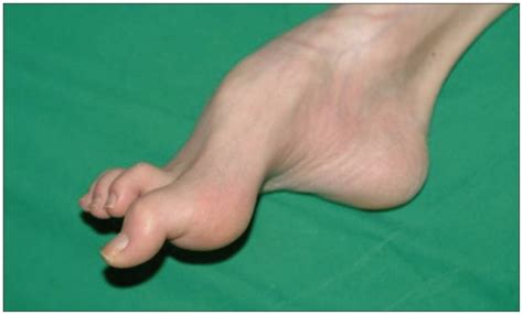 The patient's right foot shows deformities of pes cavus and hammertoes. | Download Scientific ...