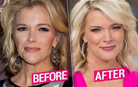 Megyn Kelly Facelift: Did She Get Plastic Surgery?