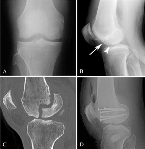 A 52-year-old male with Hoffa fracture of the medial femoral condyle ...