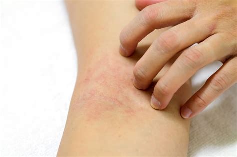 Top Five Allergic Reaction Symptoms to Insect Bites - The Pest Rangers