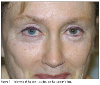 Skin Disorders in Older Adults: Age-Related Pigmentary Changes | Consultant360