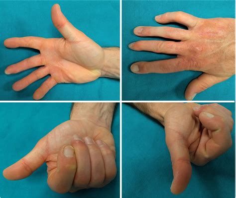 Treatment of finger degloving injury with acellular dermal matrices: Functional and aesthetic ...