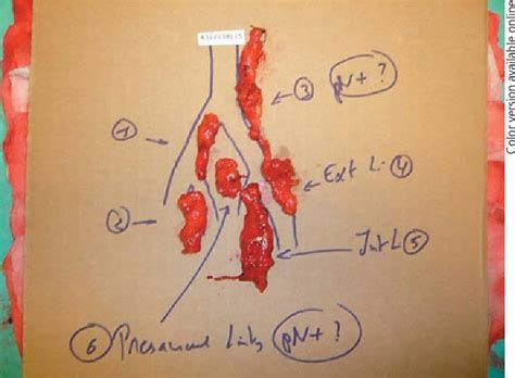 Figure 1 from Salvage Pelvic Lymph Node Dissection after Radical ...