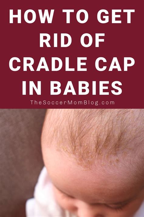 How to Get Rid of Cradle Cap - The Soccer Mom Blog