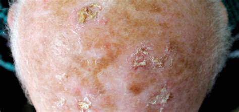 Pre Skin Cancer Keratosis