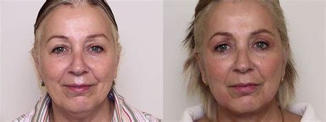 Neck Lift (Submentoplasty) Before and After Pictures Case 43 | Atlanta, Georgia | Buckhead ...