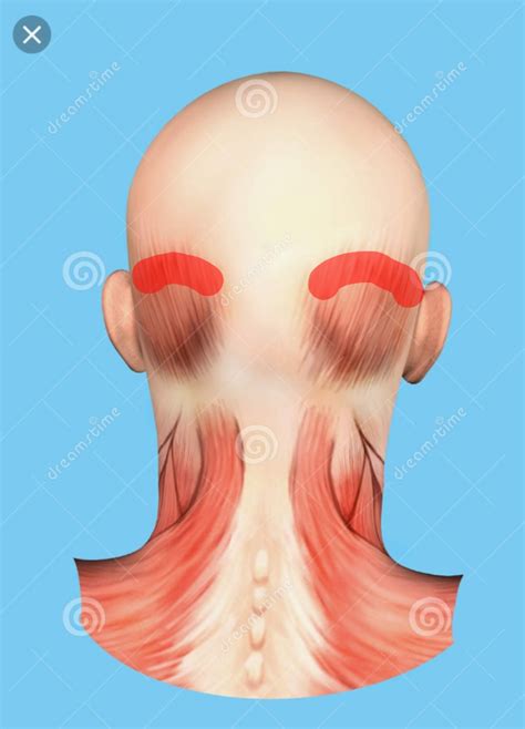 Pain and swelling on back of head. Marked in red. : r/DiagnoseMe